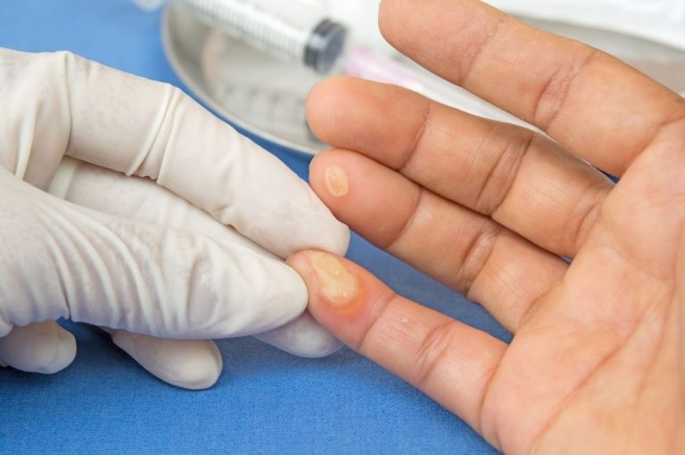 Warts And Verrucas Dilek Eryilmaz Md Msc Dermatology 
